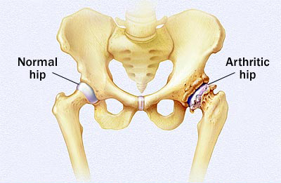 műtét artrózis 4 fokos térdkezelés csípőízületek osteoarthritis tünetei és kezelése
